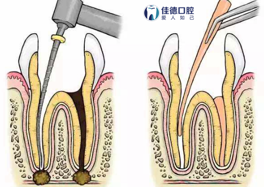 根管的治疗