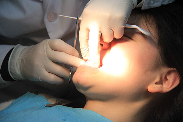 合肥牙齿根管的治疗