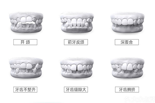 牙齿畸形