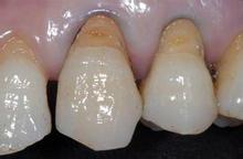 牙齿楔状缺损如何修复？