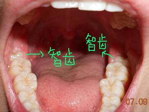 什么样的智齿应该拔除？