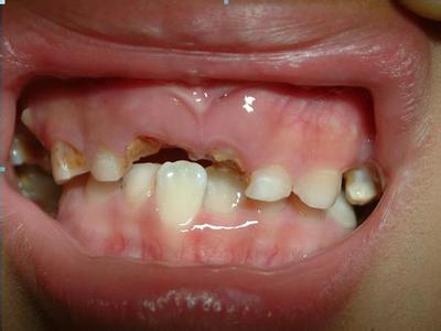 乳牙龋坏会引发哪些危害？