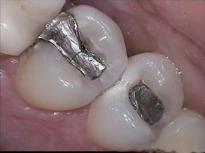 蛀了牙的治疗方法有哪些
