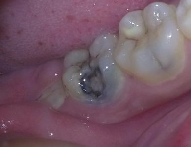 蛀了牙的原因和危害有哪些？