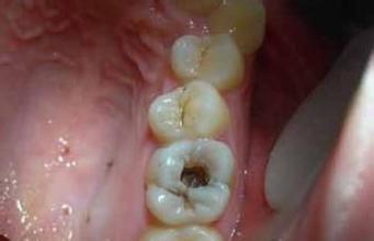 哪些因素容易导致蛀了牙？