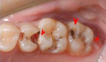 蛀了牙引发的多种危害?