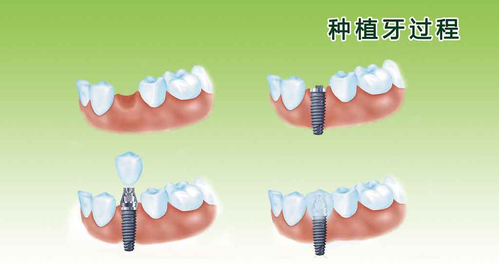 合肥种植牙多少钱