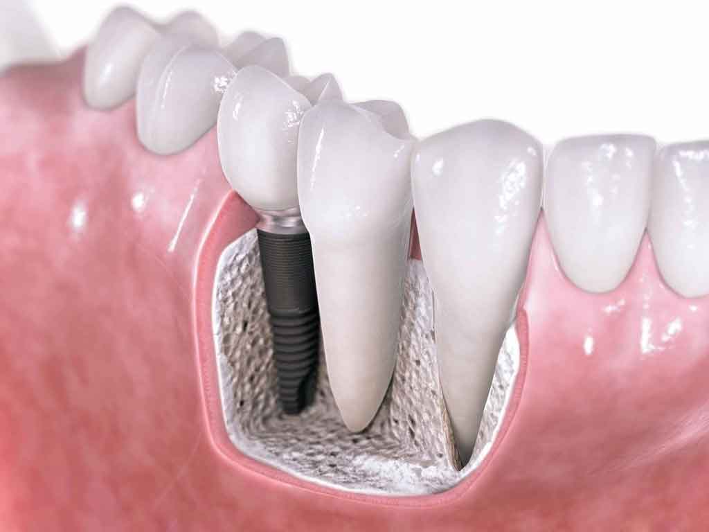 合肥种植牙技术哪家好？
