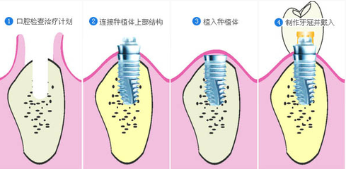 合肥种植牙大概要多少钱?