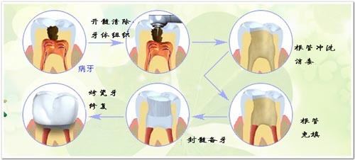 合肥补牙洞多少钱？