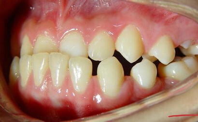 牙龈出血可能是牙髓发炎