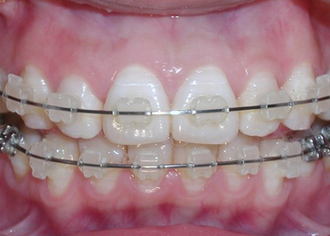 合肥做隐形牙齿矫正哪家好？