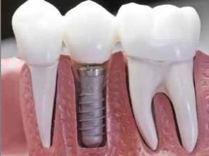种植牙和传统假牙相比有哪些优势？