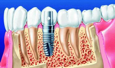 种植牙的植入体材料如何选择?