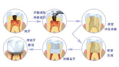 合肥牙髓发炎做根管的治疗的价格是多少？