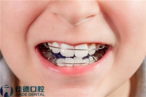 合肥儿童牙齿矫正牙科