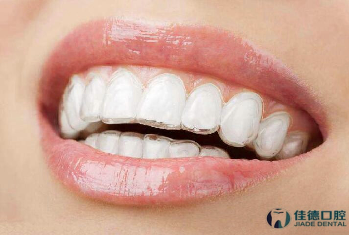 合肥矫正牙齿有几种方法
