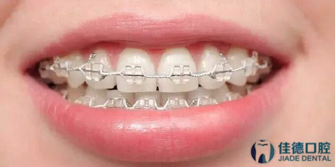 合肥矫正牙齿有几种方法