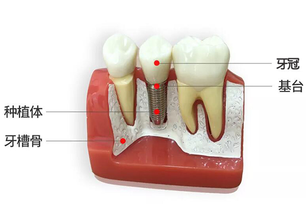 种植牙价格