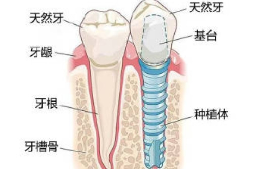 合肥的口腔医院种植牙多少钱