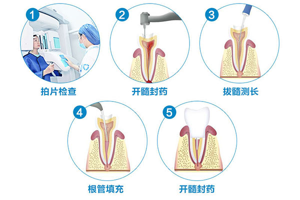 根管的治疗
