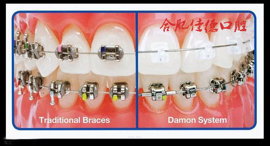 合肥牙齿矫正价格多少钱?