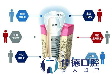 合肥种植牙牙科哪家好？