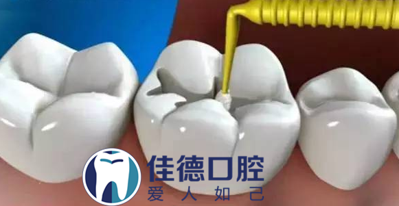 合肥的口腔医院补牙多少钱？