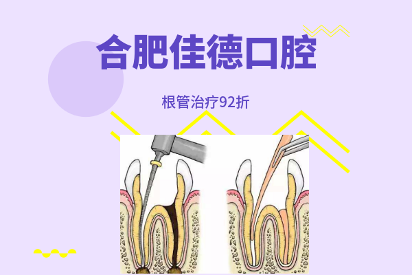 合肥牙齿根管的治疗要多少钱？