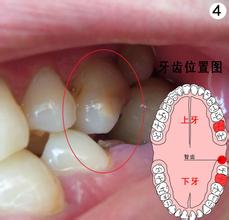智齿术后护理的几大措施
