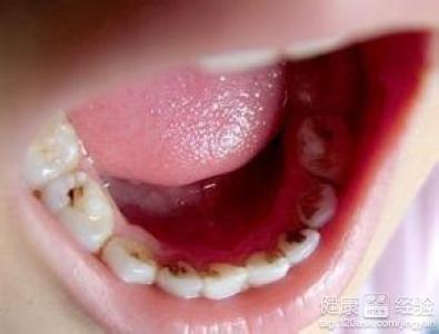 龋坏是传染病吗