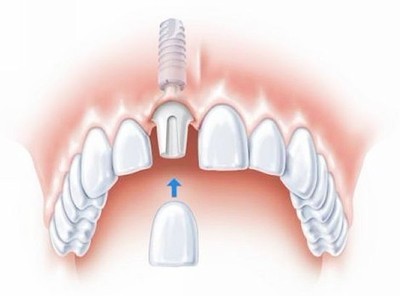 合肥做种植牙的在哪里？