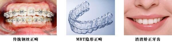 牙齿正畸的适合年龄是在多少？