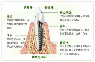 微创种植牙有哪些优点？