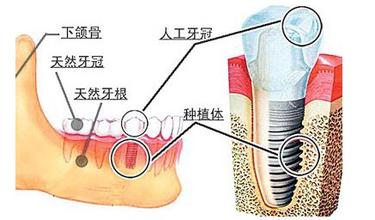 种植牙材料需符合哪些要求？