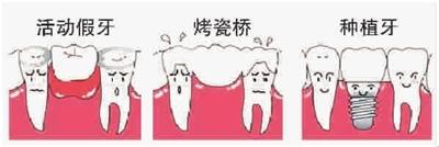 做种植牙有年龄限制吗？