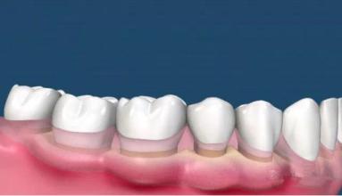 怎么样预防牙结石?