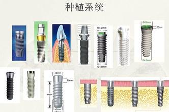 合肥好的种植牙是哪家？