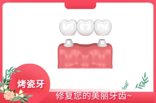 合肥烤瓷牙价格是多少