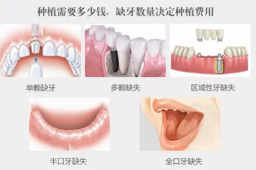 合肥哪个牙科种植牙技术好、佳德口腔种牙