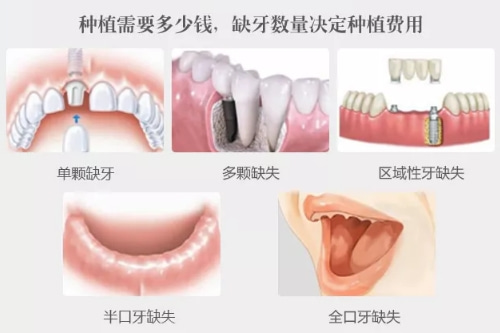 合肥种牙多少钱、佳德口腔种植牙
