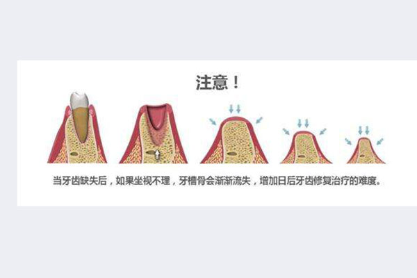 牙槽骨骨量