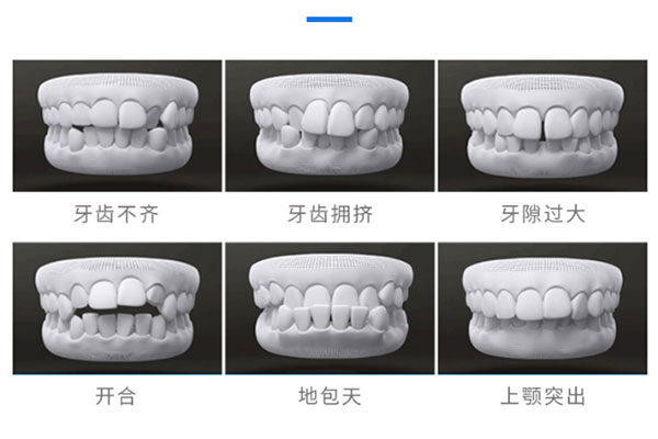 合肥隐形牙齿矫正