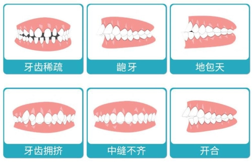 隐适美隐形矫正 合肥佳德口腔