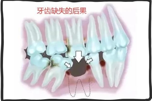 合肥种植牙齿价格是多少、种植牙、牙齿缺失